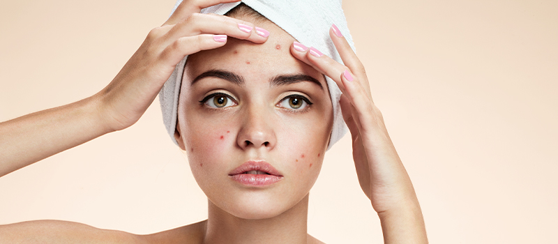 geld Antecedent Seraph NikkieTutorials vertelt: Last van acne? Zo kom je er vanaf!